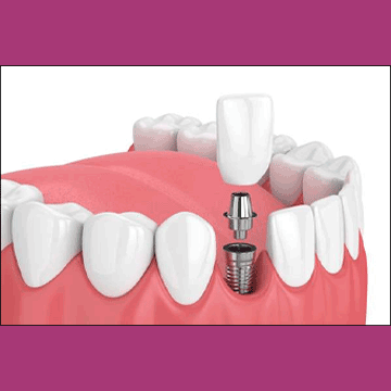 Best Dental Implants in South Bopal, North Bopal, Sobo Center, Ghuma, Shela and Ahmedabad