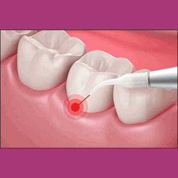 Best Dental Painless Laser Gum Surgery in South Bopal, North Bopal, Sobo Center, Ghuma, Shela and Ahmedabad