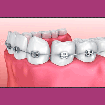 Best Dental Dental Braces in South Bopal, North Bopal, Sobo Center, Ghuma, Shela and Ahmedabad