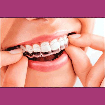 Best Dental Clear Aligners in South Bopal, North Bopal, Sobo Center, Ghuma, Shela and Ahmedabad