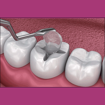 Best Dental Dental Fillings in South Bopal, North Bopal, Sobo Center, Ghuma, Shela and Ahmedabad