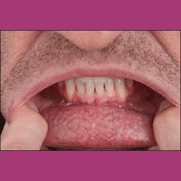 Best Dental Oral Cancer Treatment in South Bopal, North Bopal, Sobo Center, Ghuma, Shela and Ahmedabad