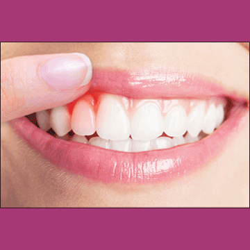 Best Dental Gum Treatment in South Bopal, North Bopal, Sobo Center, Ghuma, Shela and Ahmedabad