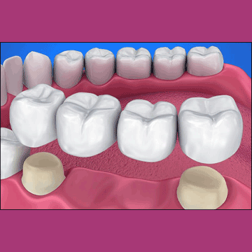 Best Dental Crown & Bridger Treatment in South Bopal, North Bopal, Sobo Center, Ghuma, Shela and Ahmedabad