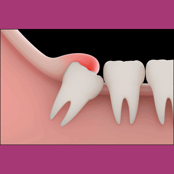 Best Dental Wisdom Tooth Removal in South Bopal, North Bopal, Sobo Center, Ghuma, Shela and Ahmedabad