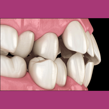Best Dental Misaligned Teeth Treatment in South Bopal, North Bopal, Sobo Center, Ghuma, Shela and Ahmedabad