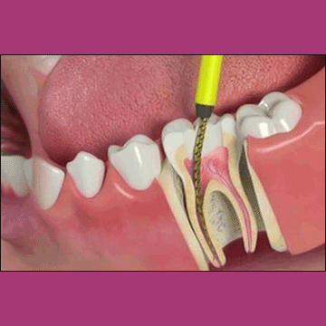 Best Dental Root Canal Treatment (RCT) in South Bopal, North Bopal, Sobo Center, Ghuma, Shela and Ahmedabad