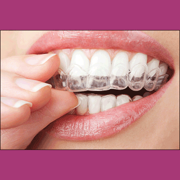 Best Dental Teeth Whitening in South Bopal, North Bopal, Sobo Center, Ghuma, Shela and Ahmedabad