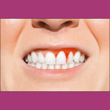 Best Dental Gum Disease in South Bopal, North Bopal, Sobo Center, Ghuma, Shela and Ahmedabad