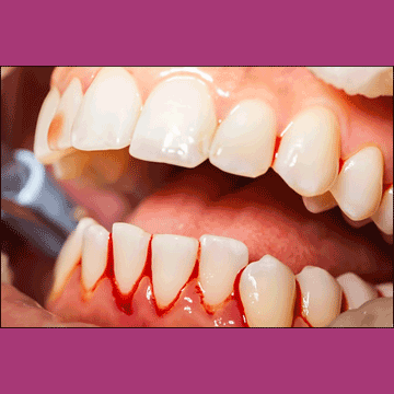 Best Dental Bleeding Gums Treatment in South Bopal, North Bopal, Sobo Center, Ghuma, Shela and Ahmedabad