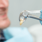 Wisdom Tooth Removal