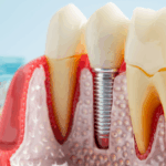 Root Canal Treatment