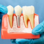 Root Canal Treatment in South Bopal