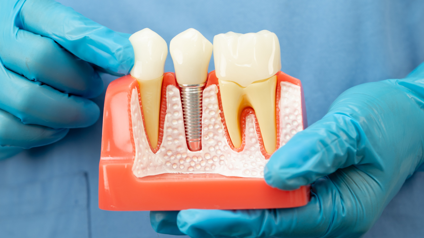 Root Canal Treatment in South Bopal