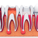 Root Canal Treatment