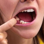 Wisdom Tooth Removal in Shela