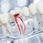 Root Canal Treatment in South Bopal