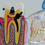 Is a Crown Necessary After a Root Canal? Everything You Need to Know