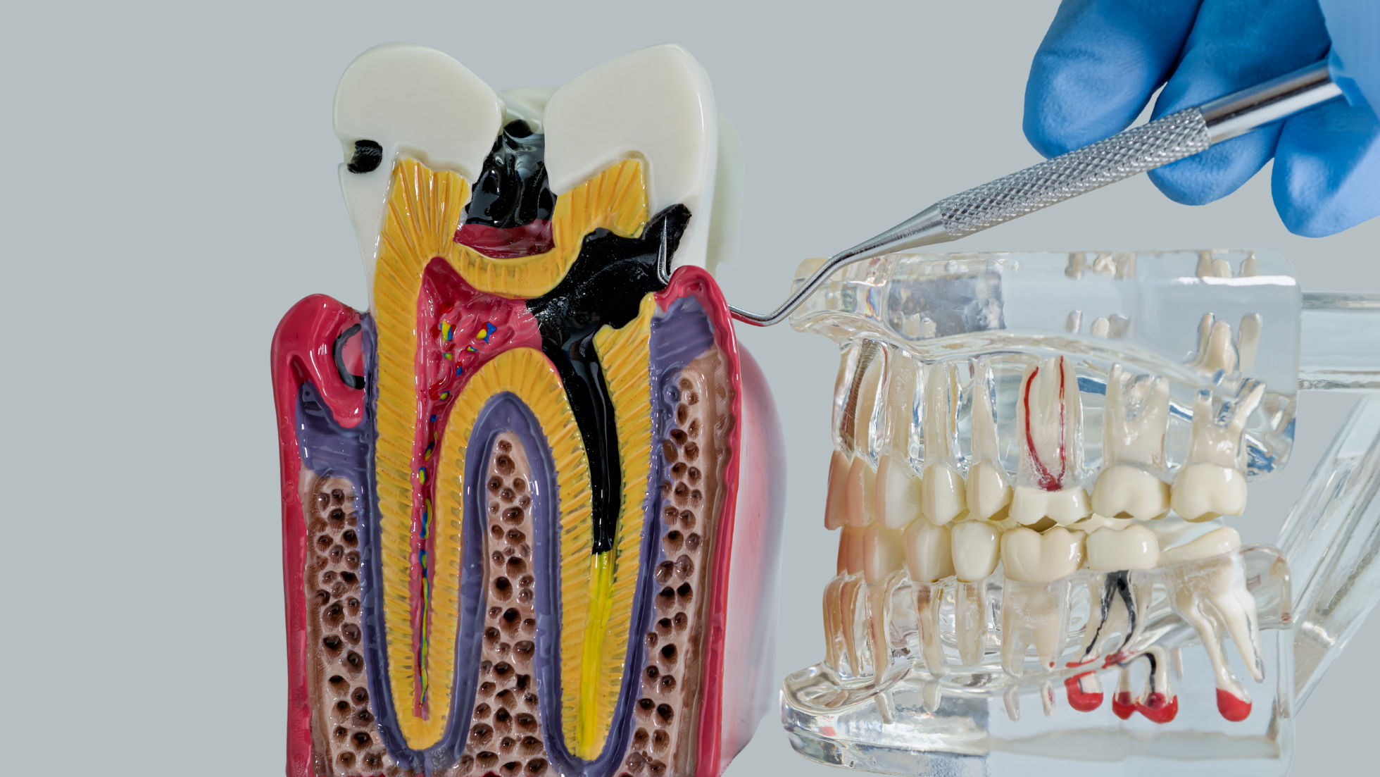 Is a Crown Necessary After a Root Canal? Everything You Need to Know