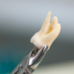 Wisdom Tooth Removal in Shela: Symptoms, Treatment Options, and Healing Time