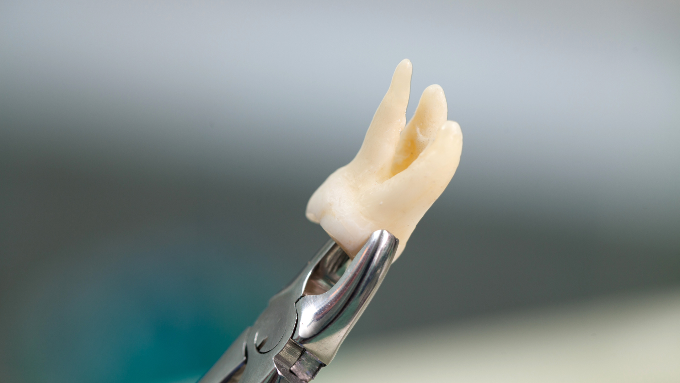 Wisdom Tooth Removal in Shela: Symptoms, Treatment Options, and Healing Time
