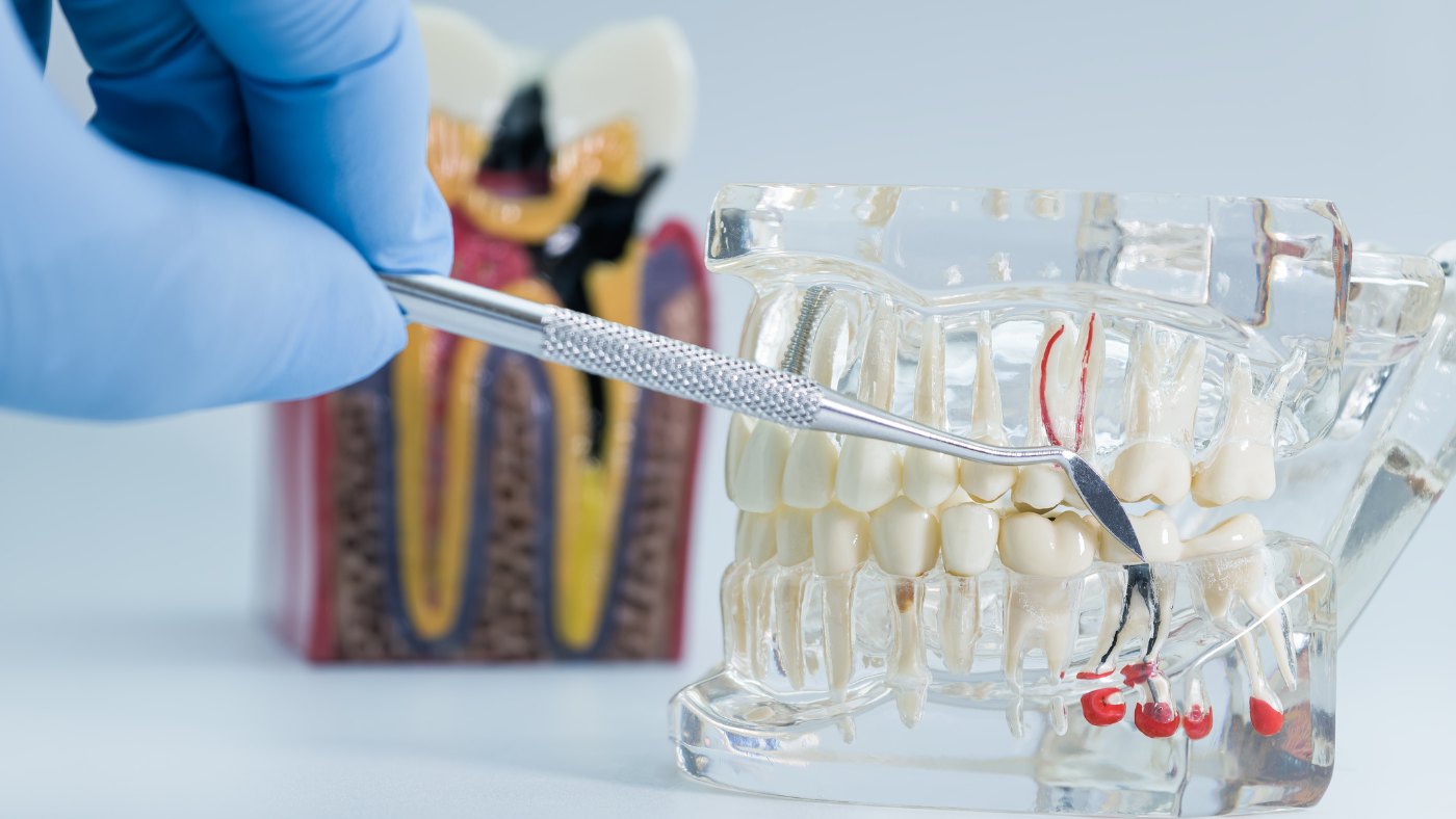 When and Why Root Canal Treatment Becomes Necessary for Tooth Preservation